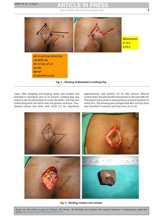 cases. After prepping and draping, lesion was marked and
included in rhomboid area to be excised. Limberg ﬂap was
raised as per the dimensions to cover the defect. The ﬂap was
raised along with the fascia over the gluteus maximus. Two-
layered closure was done with vicryl 2-0 for adipofacial
approximation and prolene 3-0 for skin closure. Minivac
suction drain was placed after hemostasis in 160 cases (88.1%).
The patient was nursed in prone position or lateral position for
initial 24 h. The dressing was changed after 48 h and the drain
was removed if contents were less than 10–15 ml.
Fig. 1 – Planning of Rhomboid or Limberg Flap
Fig. 2 – Marking, incision and excision
a p o l l o m e d i c i n e x x x ( 2 0 1 5 ) x x x – x x x 3
APME-309; No. of Pages 7
Please cite this article in press as: Khanna AK, Tiwary SK. Pilonidal sinus disease with especial reference to Limberg ﬂap, Apollo Med.
(2015), http://dx.doi.org/10.1016/j.apme.2015.07.013
 