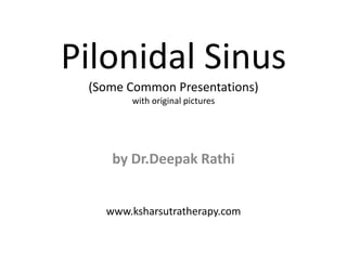 Pilonidal Sinus
(Some Common Presentations)
with original pictures
by Dr.Deepak Rathi
www.ksharsutratherapy.com
 