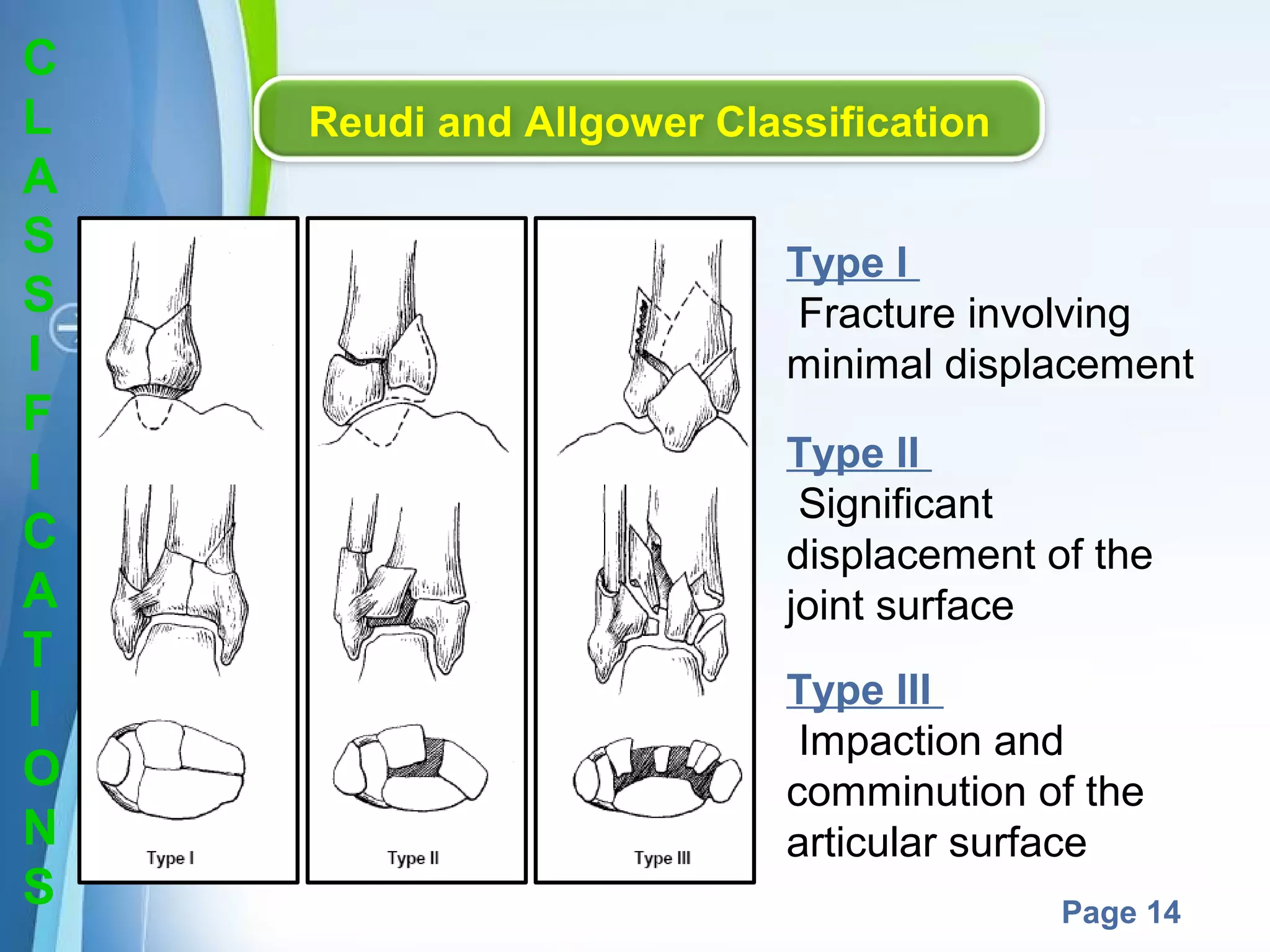 C
L
A
S
S
I
F
I
C
A
T
I
O
N
S

Reudi and Allgower Classification
Type I
Fracture involving
minimal displacement
Type II
Significant
displacement of the
joint surface
Type III
Impaction and
comminution of the
articular surface
Powerpoint Templates

Page 14

 