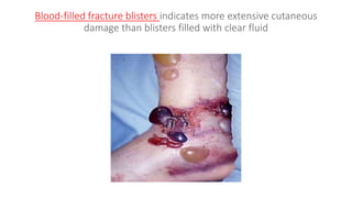 Blood-filled fracture blisters indicates more extensive cutaneous
damage than blisters filled with clear fluid
 