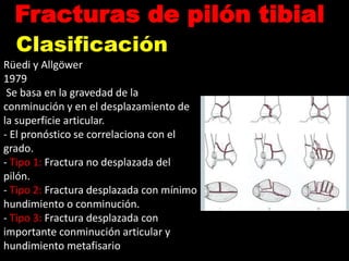 Pilon tibial | PPTX