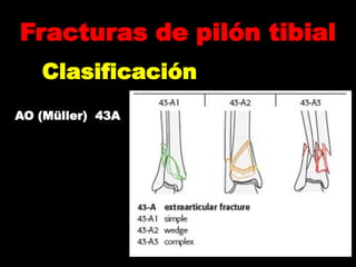 Pilon tibial | PPTX