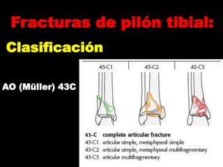 Pilon tibial | PPTX
