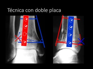 What Is Tibia Pilon Pilon tibial | PPTX