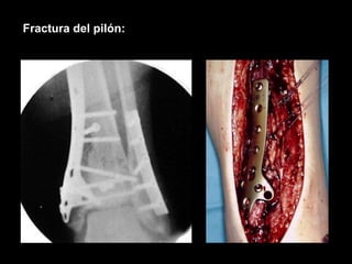 Pilon French Pilon tibial | PPTX
