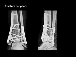 Pilon tibial | PPTX