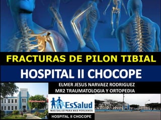 HOSPITAL II CHOCOPE
FRACTURAS DE PILON TIBIAL
ELMER JESUS NARVAEZ RODRIGUEZ
MR2 TRAUMATOLOGIA Y ORTOPEDIA
 