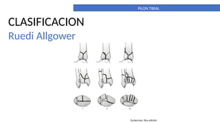 PILON TIBIAL. DEFINITIVO. importante para la anatomia | PPTX