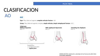 PILON TIBIAL. DEFINITIVO. importante para la anatomia | PPTX