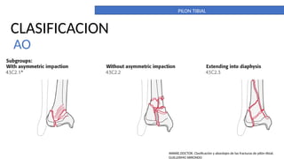 PILON TIBIAL. DEFINITIVO. importante para la anatomia | PPTX