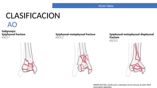PILON TIBIAL. DEFINITIVO. importante para la anatomia | PPTX