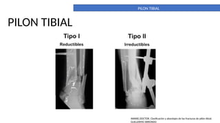 What Is Tibia Pilon PILON TIBIAL. DEFINITIVO. importante para la anatomia | PPTX