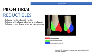 What Is Pilon PILON TIBIAL. DEFINITIVO. importante para la anatomia | PPTX