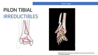 Pilon Definicion PILON TIBIAL. DEFINITIVO. importante para la anatomia | PPTX