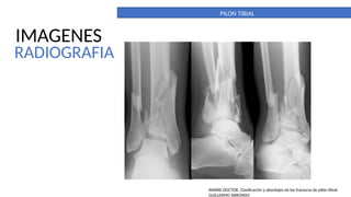 Pilon Definicion PILON TIBIAL. DEFINITIVO. importante para la anatomia | PPTX