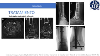 Pilon Definicion PILON TIBIAL. DEFINITIVO. importante para la anatomia | PPTX