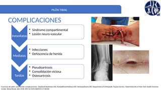 Neuro Pilon PILON TIBIAL. DEFINITIVO. importante para la anatomia | PPTX