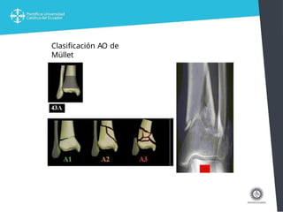 FRACTURAS DE PILON TIBIAL PILON TIBIAL .pptx