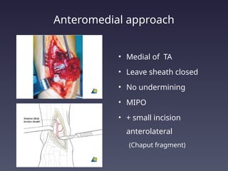 pilon tibial fractures, evidence based management | PPTX