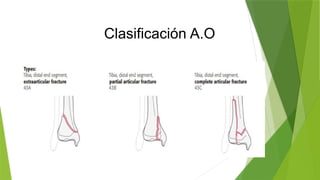 Pilon tibial jose munozx