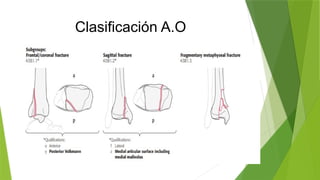 Pilon tibial jose munozx