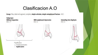 Pilon tibial jose munozx