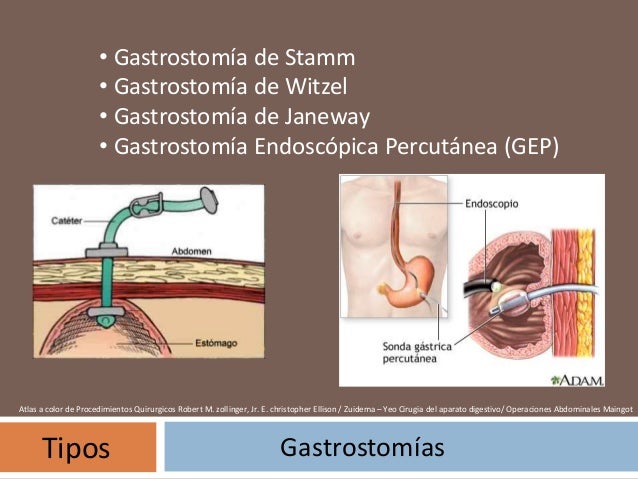 Gastrostomia