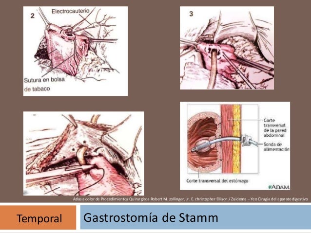 Piloroplastia, gastrostomia, yeyunostomia, ileostomia y colostomia.