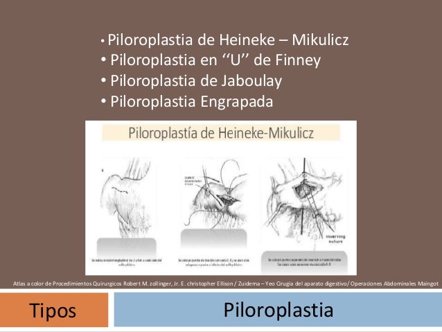 PILOROPLASTIA HEINEKE MIKULICZ EBOOK PILOROPLASTIA HEINEKE MIKULICZ EBOOK
