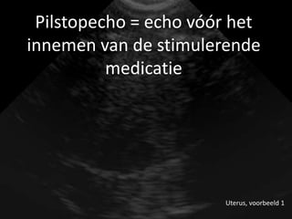 Pilstopecho = echo vóór het
innemen van de stimulerende
          medicatie




                       Uterus, voorbeeld 1
 