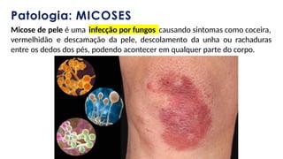 Pilula Infecções na pele e suas características de tratamento e ...