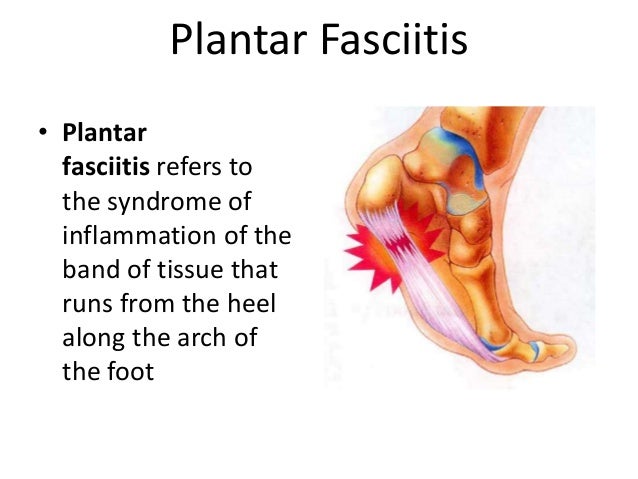 how to get rid of pinched nerve in foot