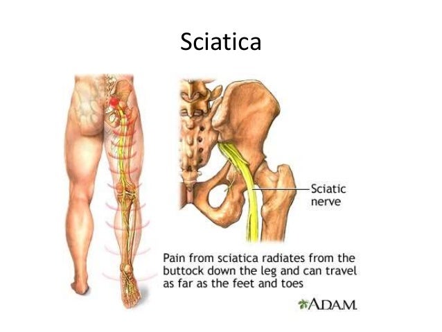 What are the signs and symptoms of a pinched nerve in the leg or back?