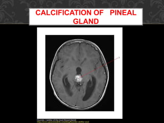 CALCIFICATION OF PINEAL
GLAND
 