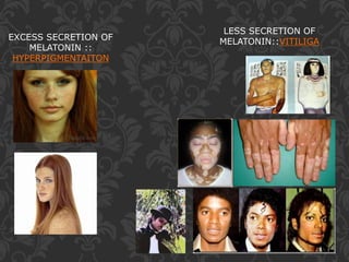LESS SECRETION OF
MELATONIN::VITILIGAEXCESS SECRETION OF
MELATONIN ::
HYPERPIGMENTAITON
 