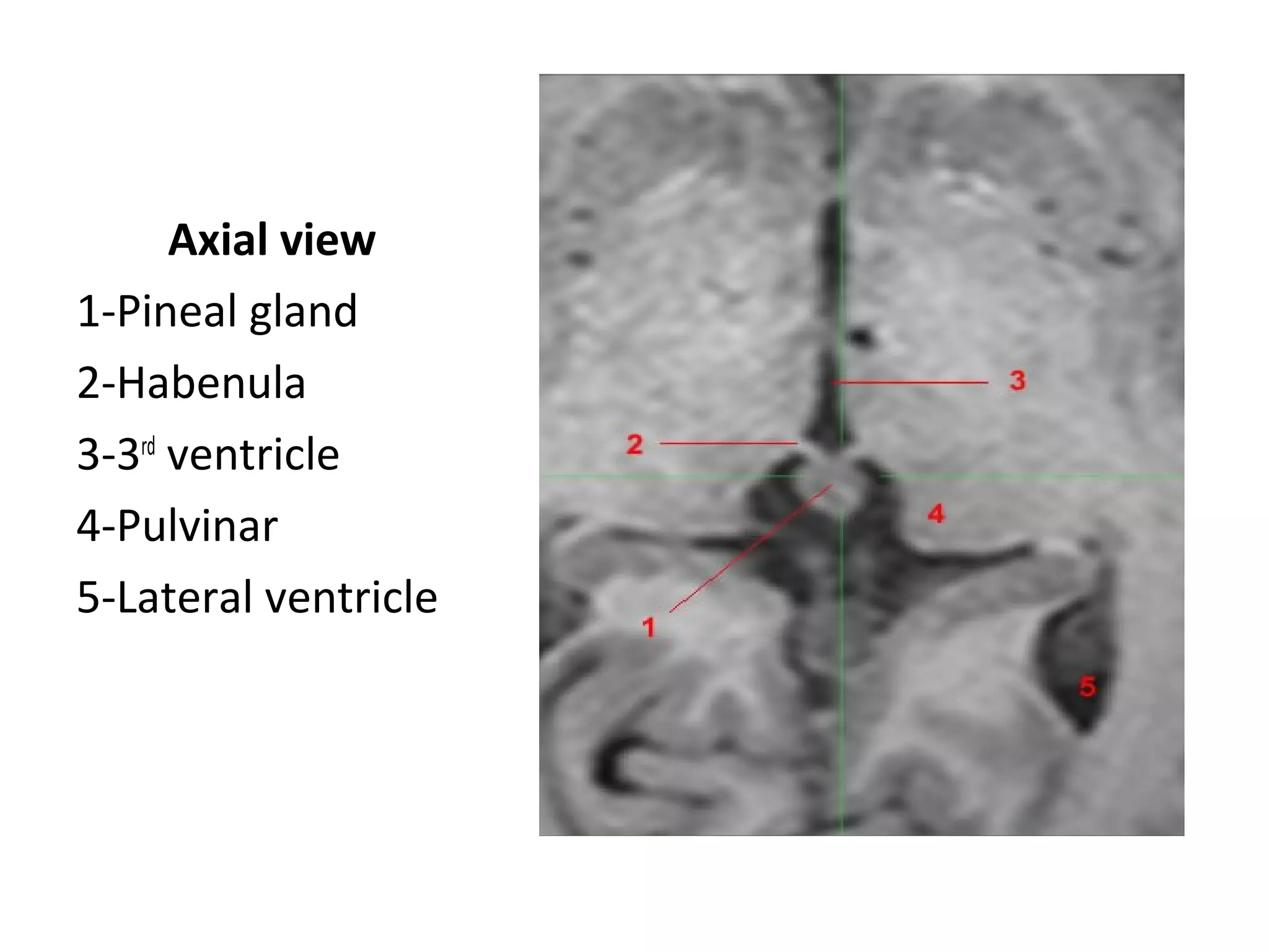 Diagnostic Imaging of Pineal Region Masses | PPT