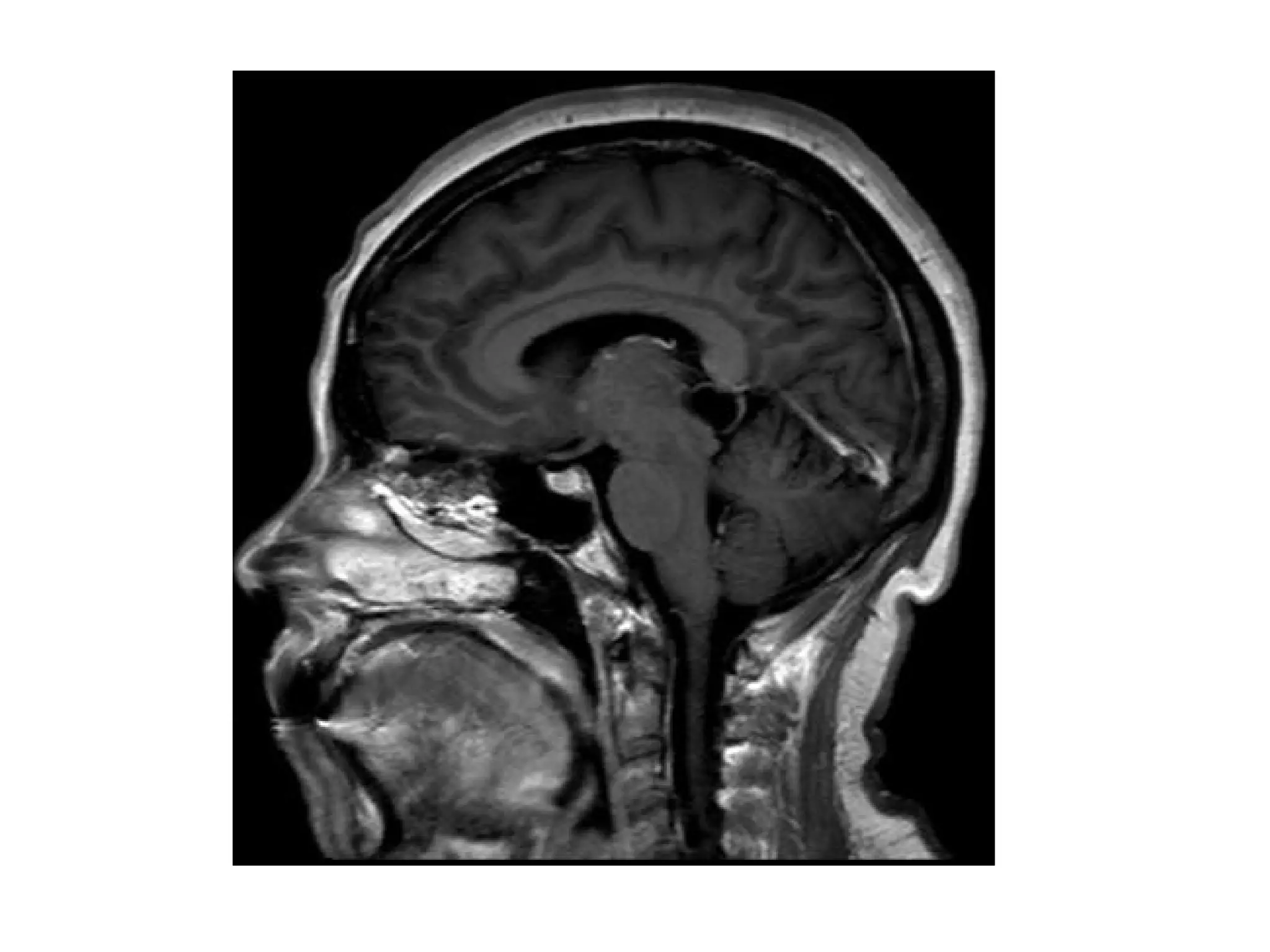 Diagnostic Imaging of Pineal Region Masses | PPT