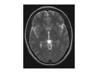 Diagnostic Imaging of Pineal Region Masses | PPT