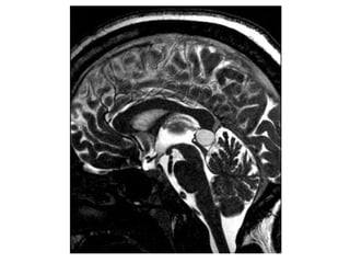 Diagnostic Imaging of Pineal Region Masses | PPT