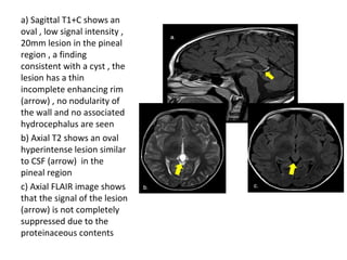 Diagnostic Imaging of Pineal Region Masses | PPT