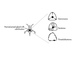Diagnostic Imaging of Pineal Region Masses | PPT