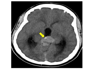 Diagnostic Imaging of Pineal Region Masses | PPT