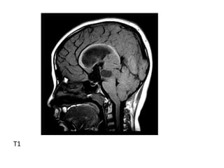 Diagnostic Imaging of Pineal Region Masses | PPT