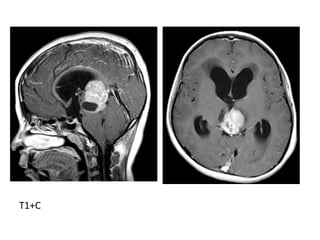 Diagnostic Imaging of Pineal Region Masses | PPT
