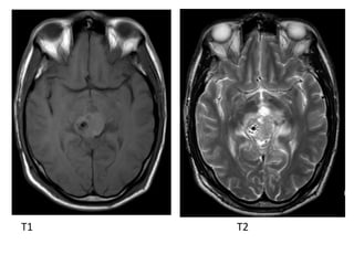 Diagnostic Imaging of Pineal Region Masses | PPT