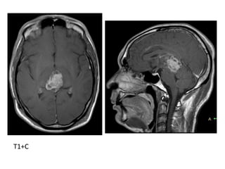 Diagnostic Imaging of Pineal Region Masses | PPT