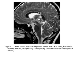 Diagnostic Imaging of Pineal Region Masses | PPT