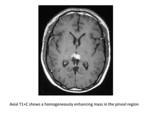 Diagnostic Imaging of Pineal Region Masses | PPT