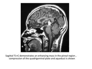 Diagnostic Imaging of Pineal Region Masses | PPT