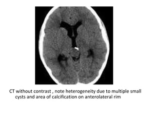 Diagnostic Imaging of Pineal Region Masses | PPT
